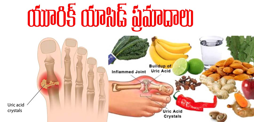 Cause of High Uric Acid Levels in the Body 2025